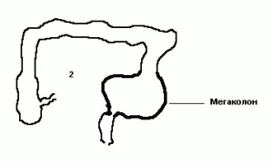 hirschsprung