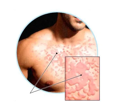 Urticaria la copii și adulți cauze și tratament