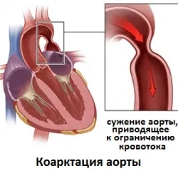 Coarctația aortei, simptomele și tratamentul patologiei