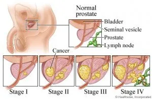 Cancer de prostată