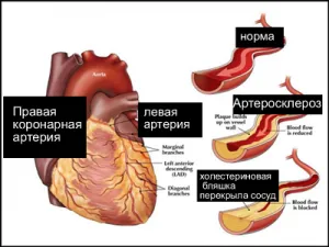 Cardioscleroza inimii, simptomele și formele bolii