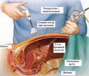 Procedurile laparoscopice sunt o metodă modernă de tratament