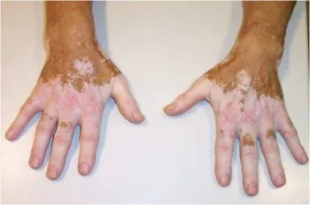 Tratamentul vitiligo cu remedii populare