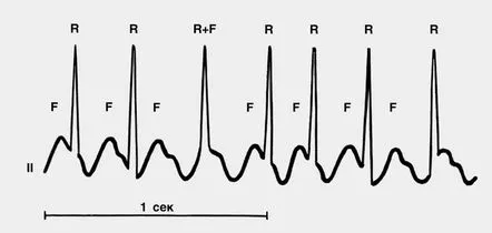 Flutter atrial pe ECG de ce se întâmplă și ce înseamnă