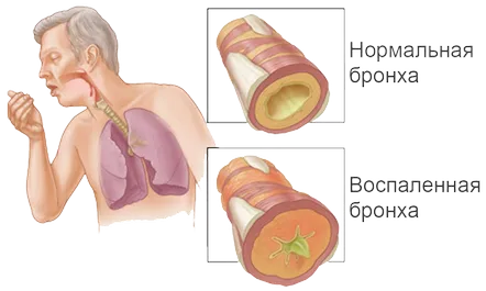 Modalități de tratare a bronșitei la copii și adulți