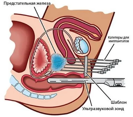 Tratamentul cu brahiterapie al cancerului de prostată