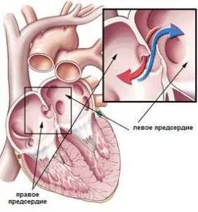 Coardă suplimentară a ventriculului stâng în patologia cardiacă sau normă