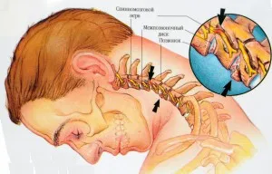 Exerciții pentru osteocondroza cervicală