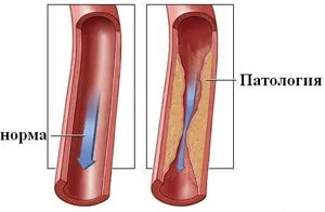 endarteritei