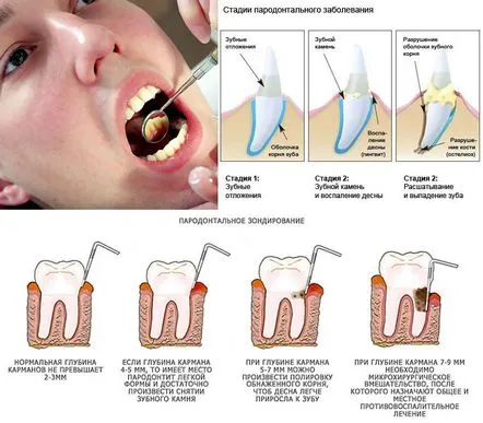 Cum să tratați boala parodontală acasă Selectăm un remediu eficient