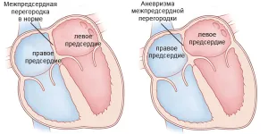 Anevrism al septului atrial, simptome și principii de tratament