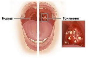 Într-adevăramigdalita infectioasa