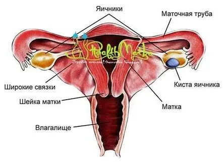 Chistul ovarian endometrioid caracteristici generale, simptome, tratament, examinare, laparoscopie.