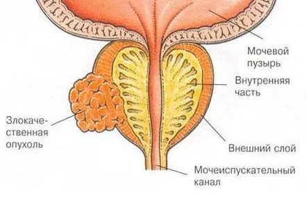 Totul despre simptomele cancerului de prostată și metodele de detectare a bolii