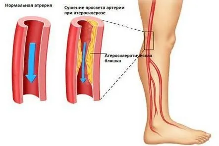 Ateroscleroza obliterată, ce fel de boală Factori de tratament