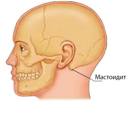 Simptomele mastoiditei cronice sau acute și tratament la domiciliu