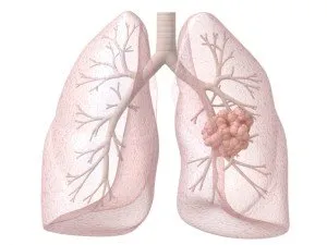 Diagnosticul și tratamentul cancerului pulmonar