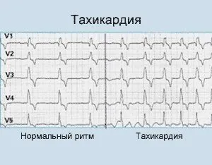 tahicardiei