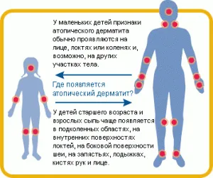 Tratamentul dermatitei atopice cu remedii populare