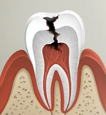 Simptomele pulpitei dentare