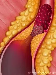 Atherosclerosis tünetek, okok, diagnózis, kezelés, műtét atherosclerosis ingyen