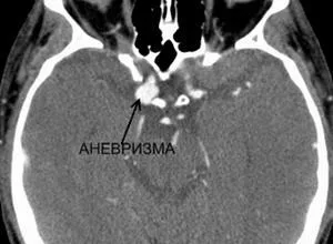 Anevrism cerebral cauze, simptome, tratament