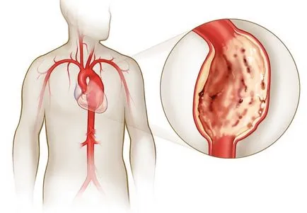 simptome anevrism aortic, ce este, extinderea porțiunii ascendente, rădăcină