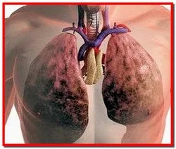 Emfizem pulmonar. Simptome, tratament cu remedii populare