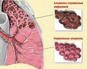 Emfizemul plămânilor semne și tratament prin metode populare