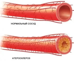 Ateroscleroza extremităților inferioare, cum să nu ratați boala