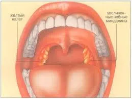Semne și tratamentul amigdalitei purulente