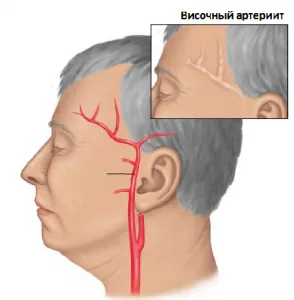 Arterita temporală, care este o boală