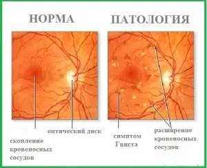 Semne, tipuri și tipuri de angiopatie retinianătratament