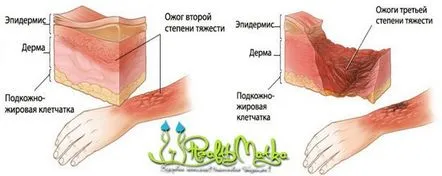 4 grade de caracteristici de arsuri, primul ajutor, sfaturi utile