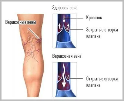 Unguente pentru varice pe picioare, TOP 10 medicamente rețete populare