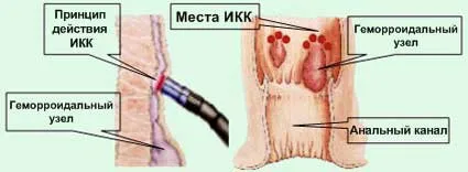 Hemoroizii pot fi vindecați fără durere și fără intervenții chirurgicale. Metode moderne minim invazive (nechirurgicale) de tratament al hemoroizilor.