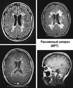 Simptomele sclerozei multiple și tratamentul prin metode populare