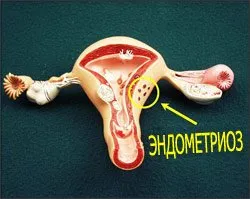 Cum să tratați endometrioza uterului Simptome, consecințe, fotografie