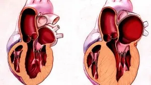 Cardiomiopatia restrictivă cauze și caracteristici ale cursului