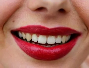 7 remedii casnice pentru inflamarea gingiilor