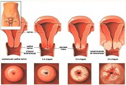 Principalele etape ale cancerului de col uterin, diagnostic și metode de tratament