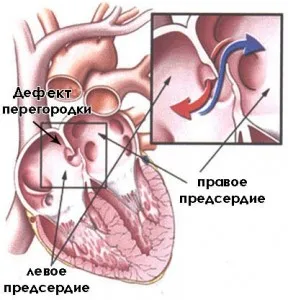 Defectul septului atrial - ce este