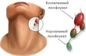 Principalele simptome și tratament ale limfadenitei