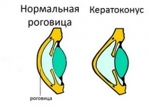 keratoconus