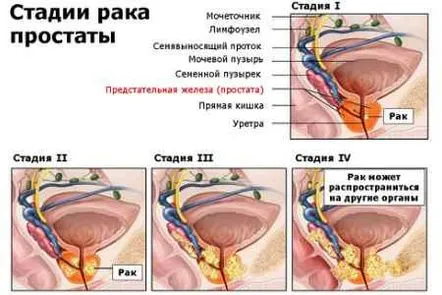 Speranța de viață în stadiul 4 a cancerului de prostată