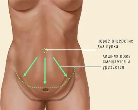 Abdominoplastie - fotografii înainte și după, descrierea operației