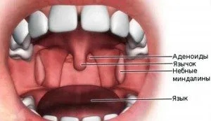 Tratamentul competent al adenoidelor la copii