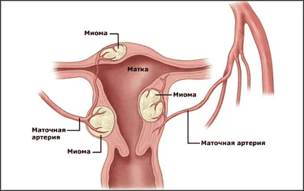 Cum se vindecă miomul uterului într-un mod popular. Ierburi, propolis, contraindicații