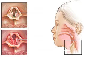 Cum evoluează laringita la adulți