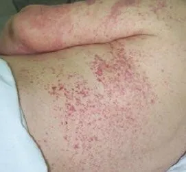 vasculita